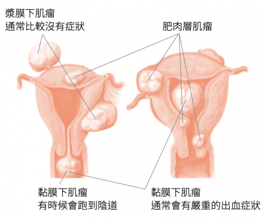 子宮肌瘤知多少？你想暸解的Ｑ＆Ａ一次告訴您