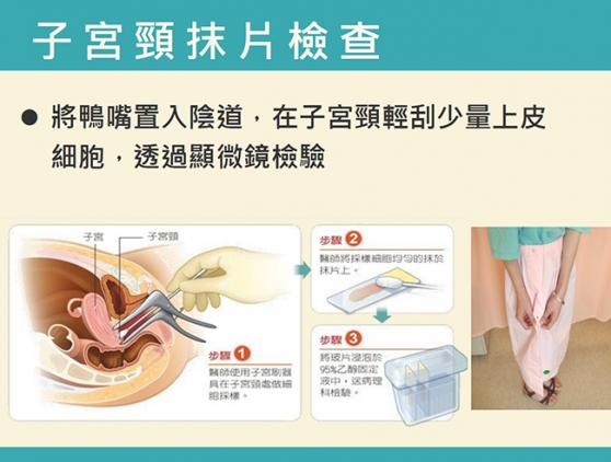 定期子宮頸抹片檢查 有效降低罹病風險