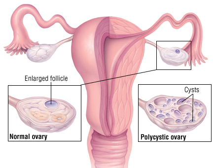 多囊性卵巢症