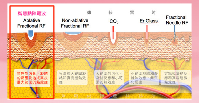 痘疤,妊娠紋,疤痕,毛孔粗大,肌膚問題,細紋,精靈電波,精靈電梭,微針