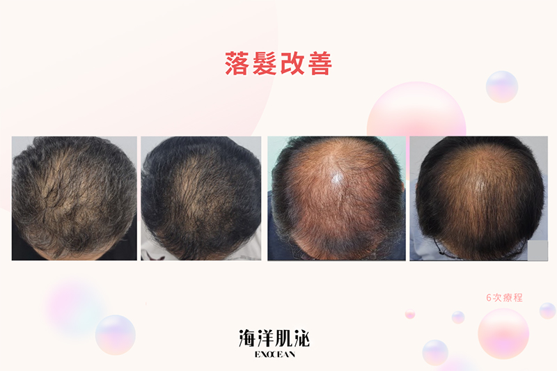 外泌體, 美人魚時尚婦產科診所, 私密處乾澀, 禿頭, 郭安妮, 高潮, 性生活